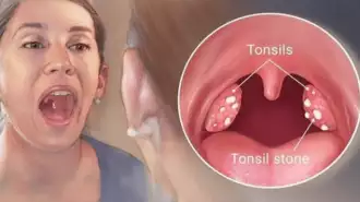 Ketahui Tentang Penyakit Amandel