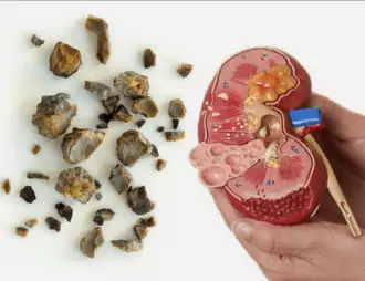 Obat Alami Batu Ginjal